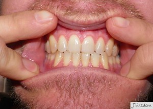 Before teeth whitening